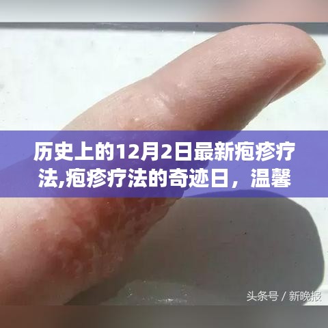 皰疹療法的奇跡日，友情與愛在歷史上的溫馨故事
