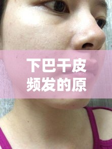 下巴干皮頻發(fā)的原因、對(duì)策及日常護(hù)理之道