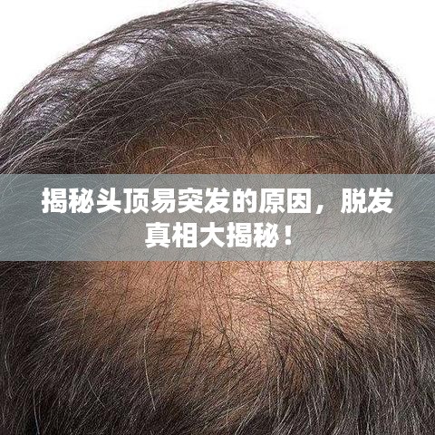 揭秘頭頂易突發(fā)的原因，脫發(fā)真相大揭秘！